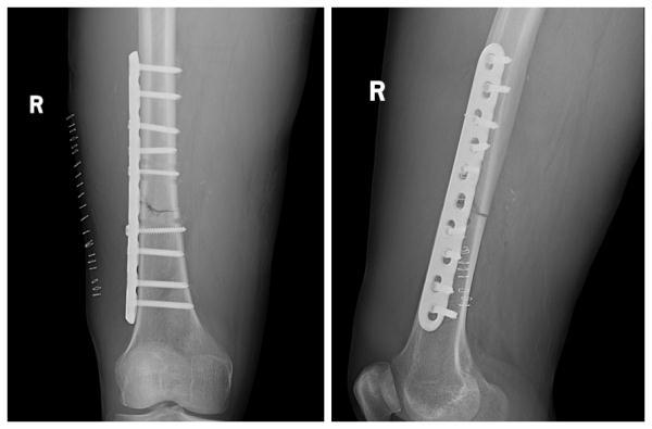 小切口治療股骨干骨折，讓意外傷無“微”不治