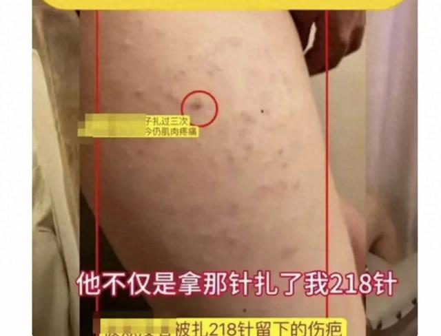山東一女生，被同桌男生用錐子在腿上扎成了馬蜂窩