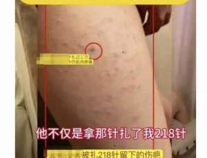 美女扎腿間(山東一女生，被同桌男生用錐子在腿上扎成了馬蜂窩)
